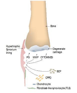 calcium crystals and osteoarthritis